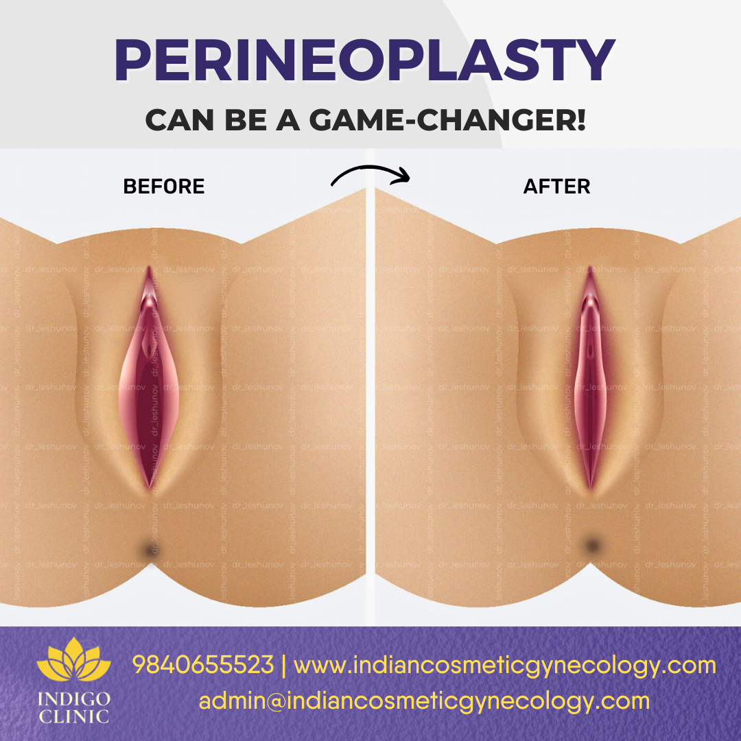 Ladies, let's talk about reclaiming our confidence and embracing our bodies! Today, I want to shed light on a life-changing procedure called Perineoplasty, which can empower you to feel your absolute best. ✨